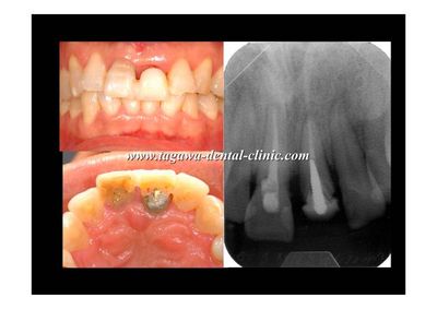 早期埋入の術前術後イメージ例5（田川歯科）